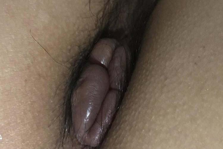 静脉曲张性外痔图