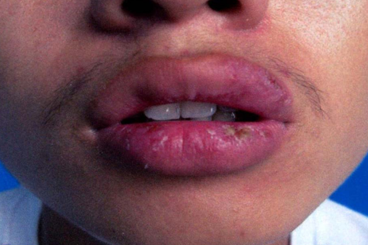 深部化脓型腺性唇炎结痂图