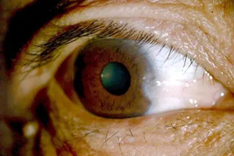 静止期翼状胬肉结膜长白斑图 静止期翼状胬肉结膜长白斑图