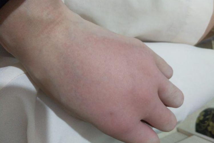 外伤手肿图 外伤手肿图