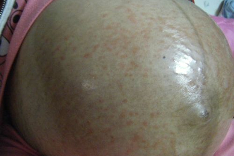 妊娠痒疹初期腹部红色丘疹图