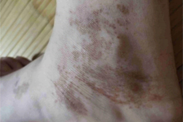 进行性色素性紫癜性皮病脚踝斑图