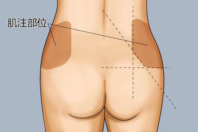 臀大肌十字法定位图