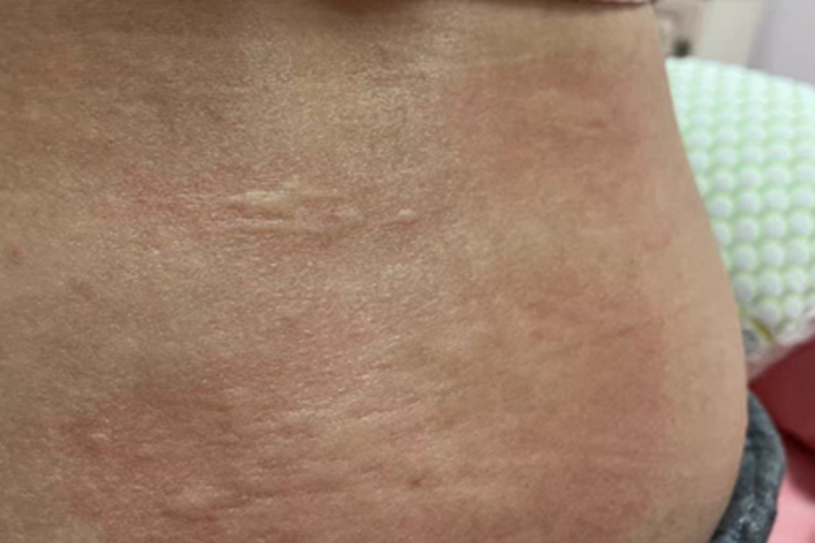 慢性自发性荨麻疹腰部疙瘩图 慢性自发性荨麻疹腰部疙瘩图