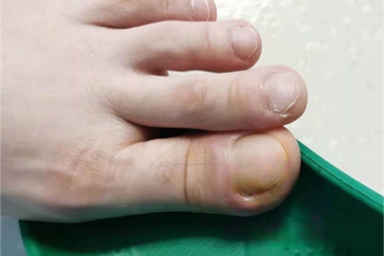 急性甲沟炎脚趾边红肿图