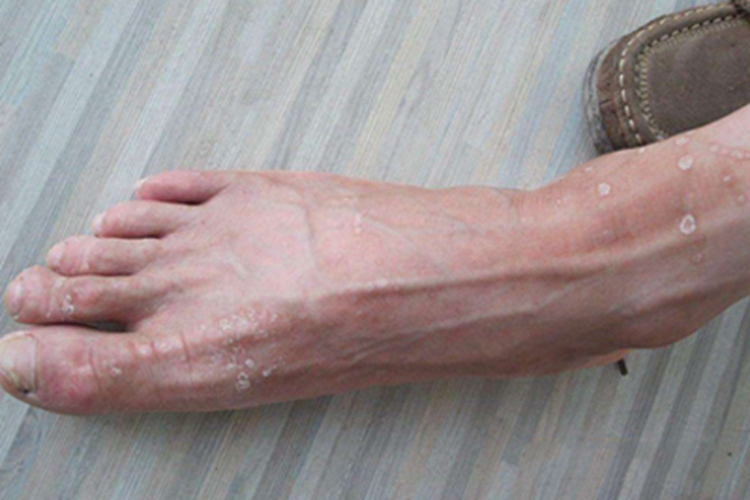 花斑糠疹脚部症状图