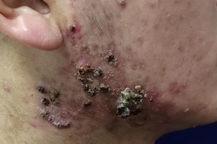 聚合性痤疮颈部结痂图