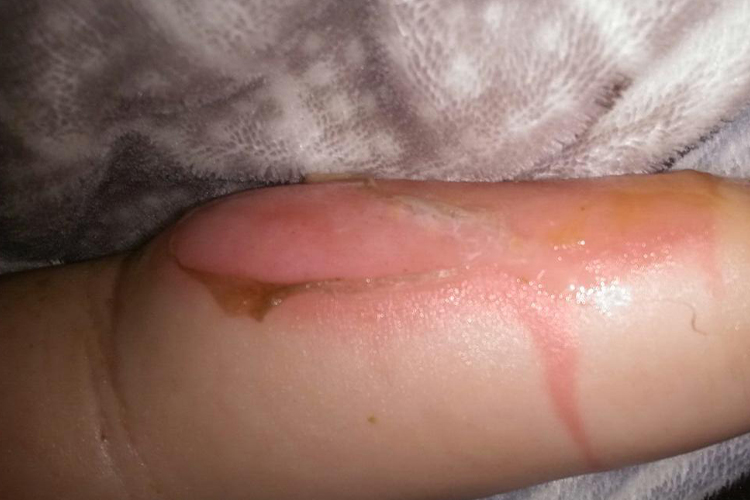 小腿烫伤浅Ⅱ度水疱破溃图