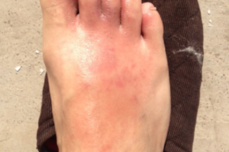 疥疮脚背一大片红斑图