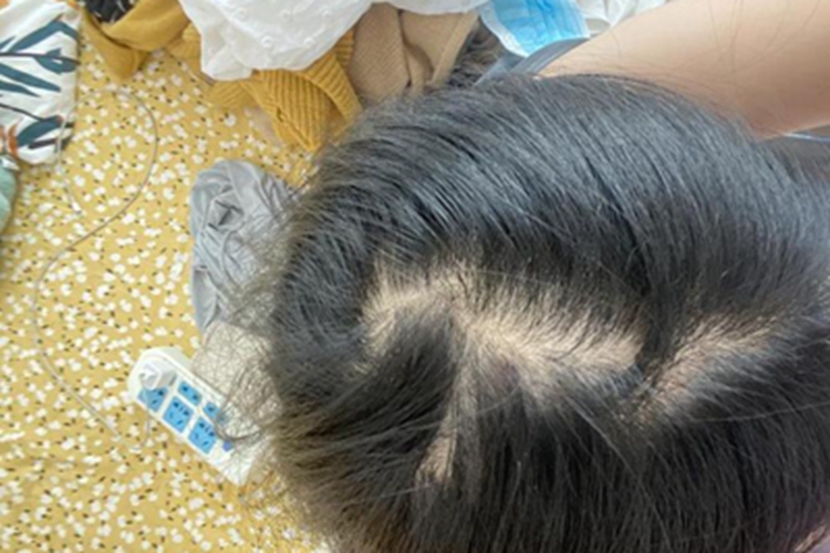 少毛症头发稀少发缝宽图