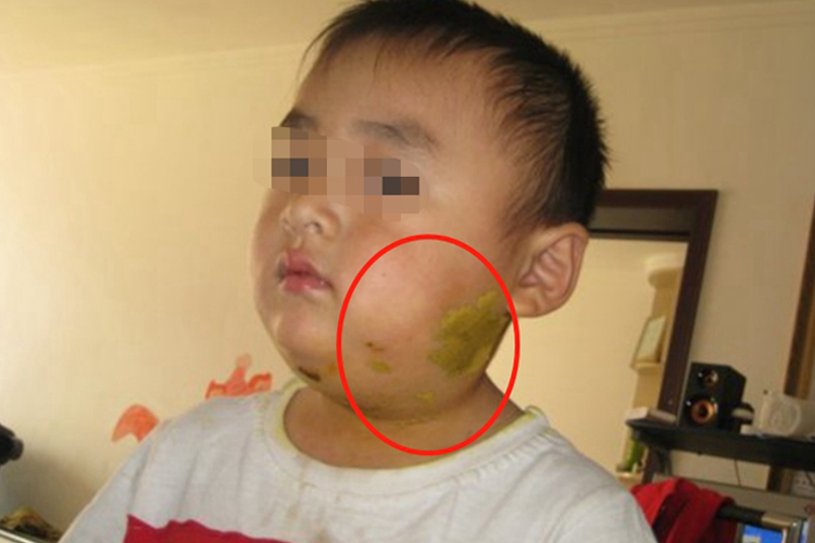 流行性腮腺炎图