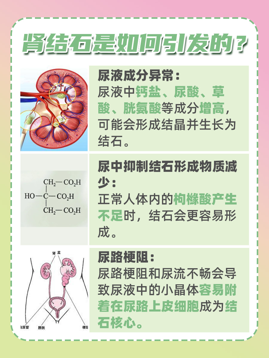 5mm肾结石，小巧但不容忽视！