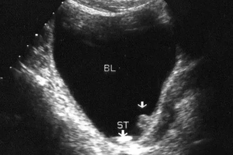 下尿路结石B超图 下尿路结石B超图