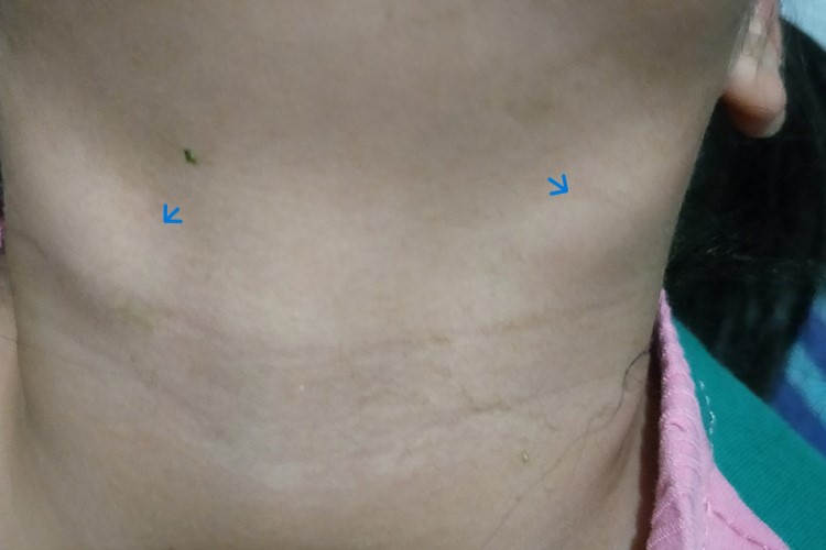 慢性淋巴结炎图