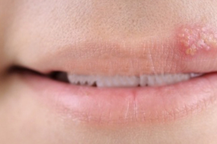 口唇疱疹上嘴唇一堆小白点图