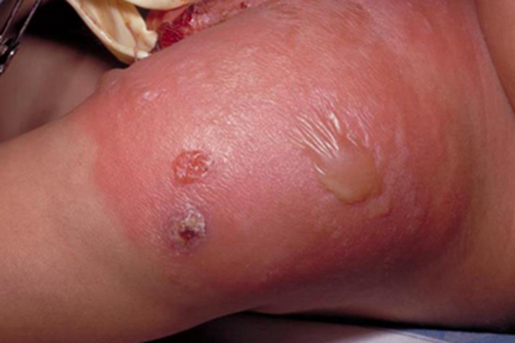 嗜酸性蜂窝织炎红肿图