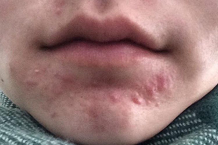 痤疮下巴红色疙瘩图