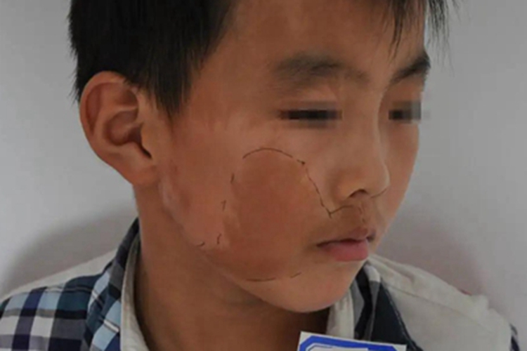 咖啡斑面部长斑图