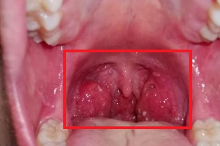 淋菌性咽炎咽后壁症状图