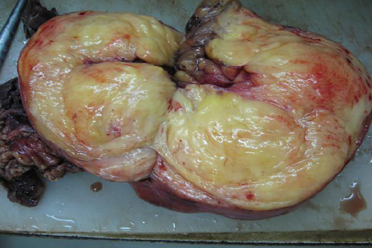 腘窝脂肪瘤图片图片