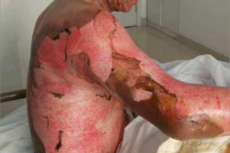 深Ⅱ度烧伤全身症状图 深Ⅱ度烧伤全身症状图