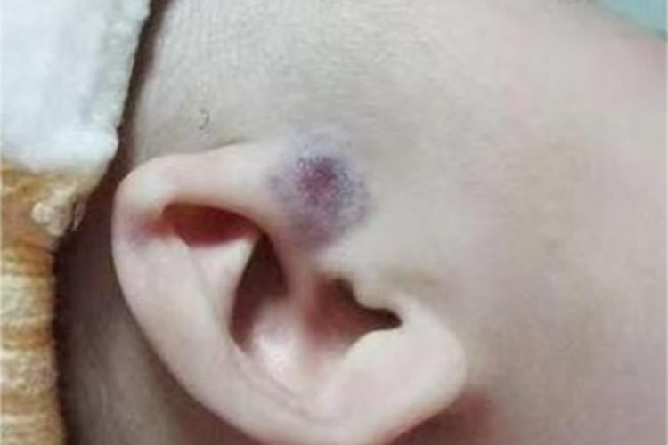 蔓状血管瘤紫斑图 蔓状血管瘤紫斑图