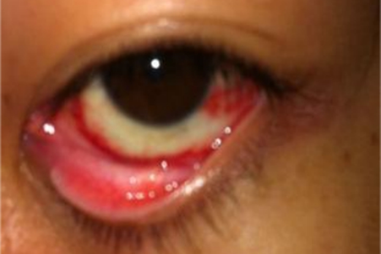 速发型过敏性结膜炎眼球有红斑图 速发型过敏性结膜炎眼球有红斑图
