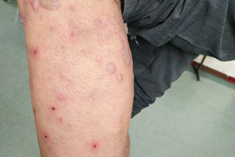 结节性痒疹小腿血痂图