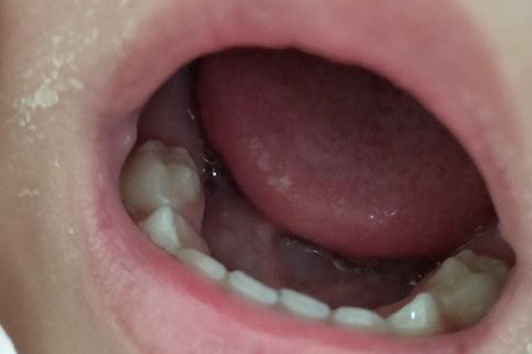 一岁半宝宝牙齿图