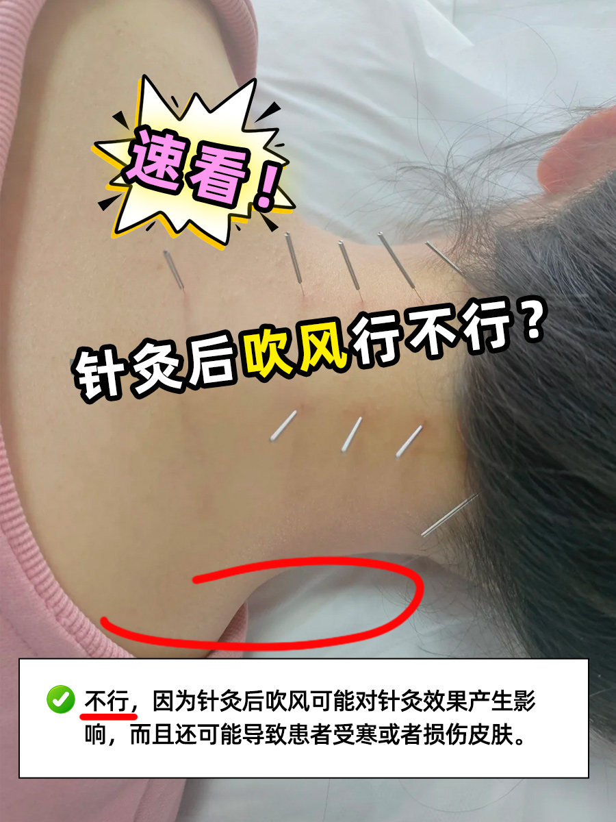 速看！针灸后吹风行不行？