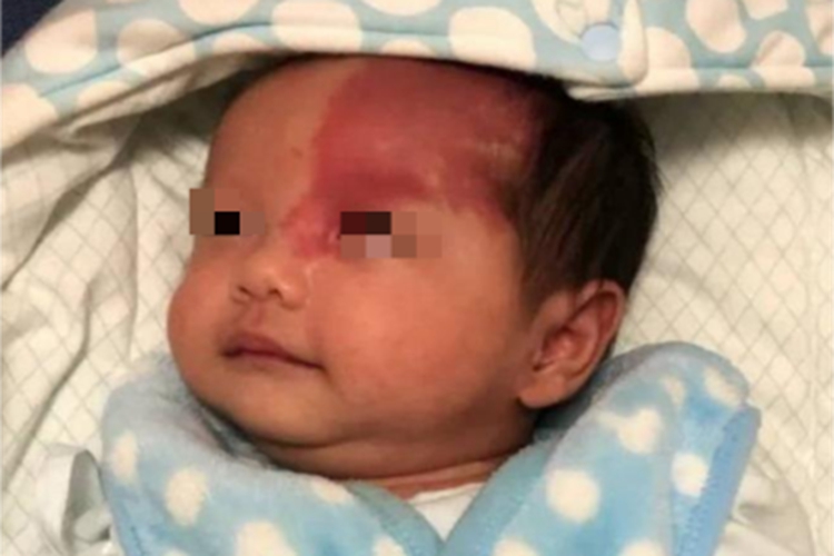 鲜红斑痣症状图