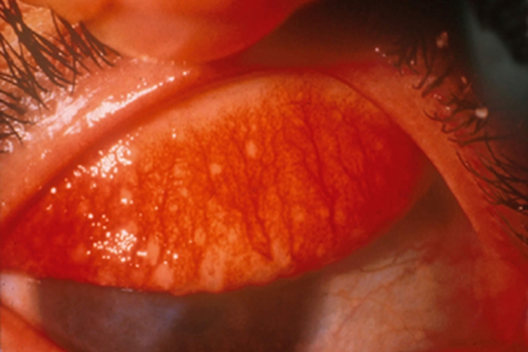 进行期沙眼白点图