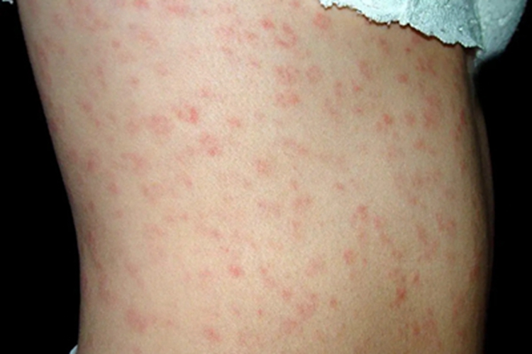 三期梅毒腹部症状图 三期梅毒腹部症状图