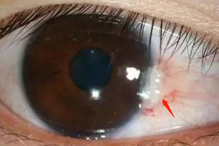 翼状胬肉白色疙瘩图 翼状胬肉白色疙瘩图