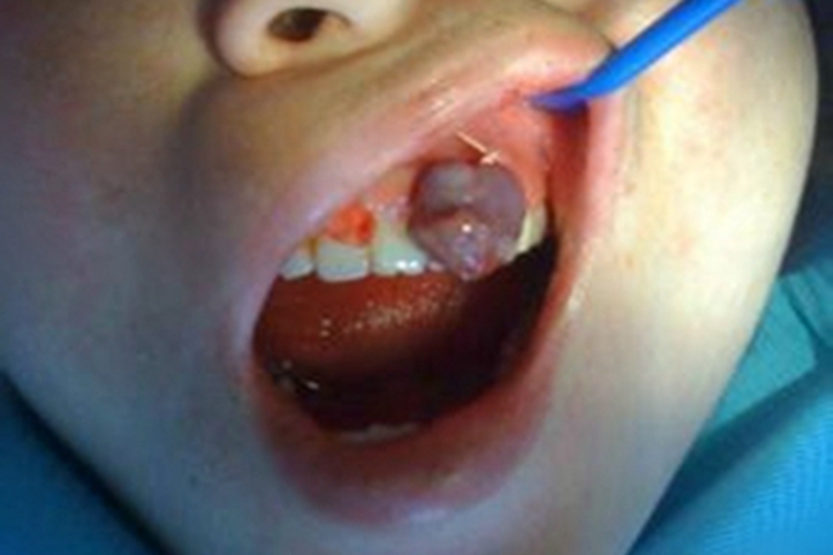 牙龈瘤大疙瘩图 牙龈瘤大疙瘩图