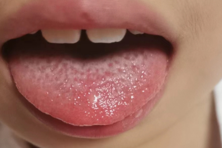 川崎病舌头小疙瘩图 川崎病舌头小疙瘩图