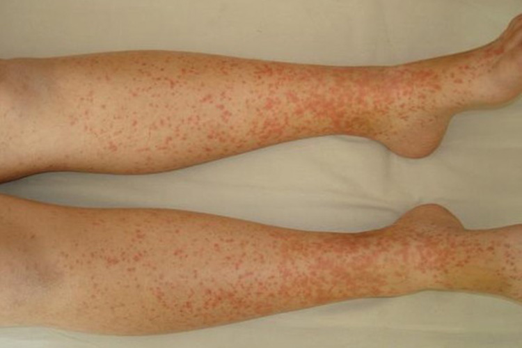 出血瘀点图皮下毛细血管破裂出血,通常表现为血液淤积于皮肤或黏膜下