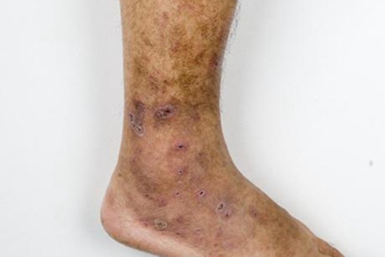 色素苔藓性紫癜样皮炎脚踝褐斑图 色素苔藓性紫癜样皮炎脚踝褐斑图