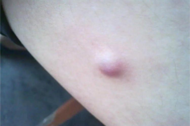 皮脂腺囊肿大腿结节图