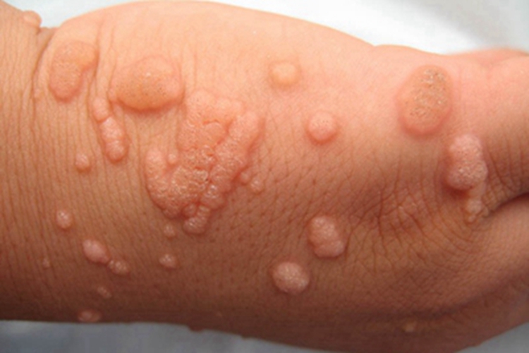 寻常疣样职业性疣赘手背硬疙瘩图