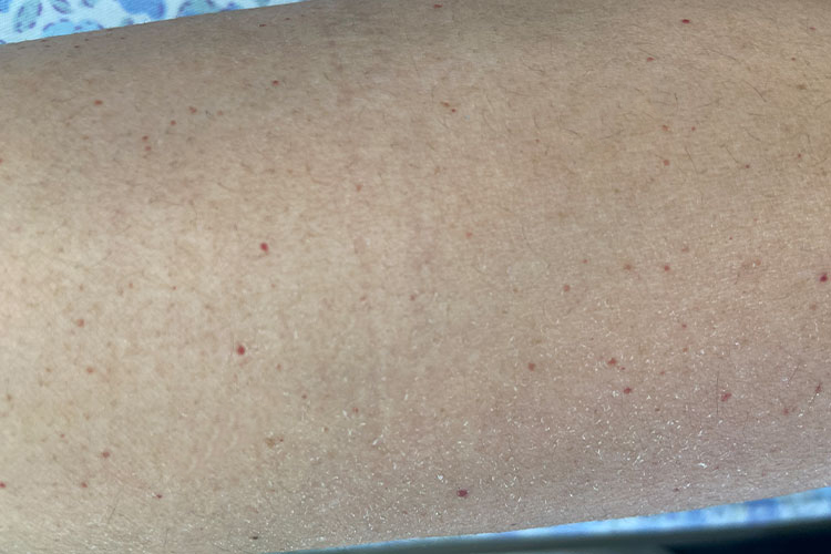 散发樱桃状血管瘤图