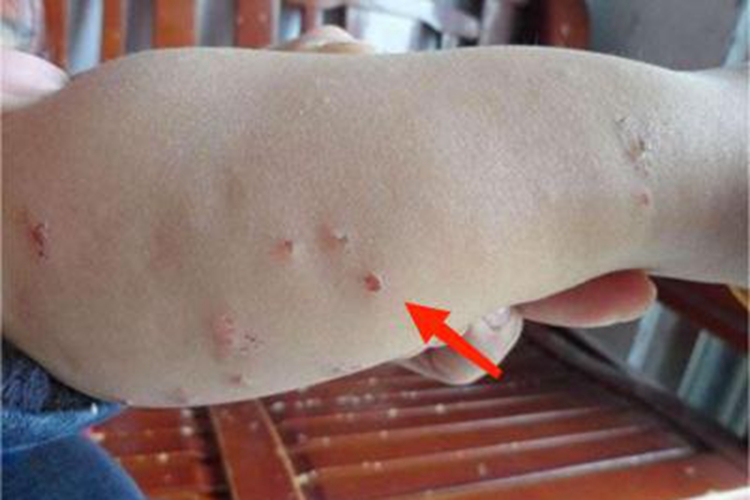 跳蚤叮咬糜烂图