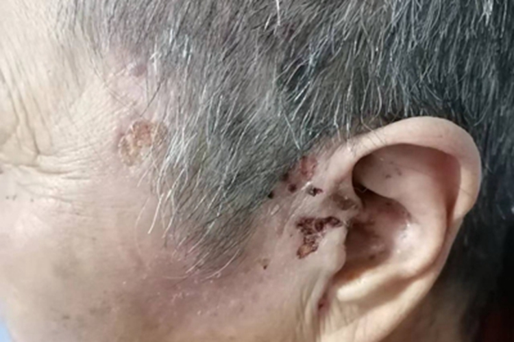 带状疱疹耳周症状图