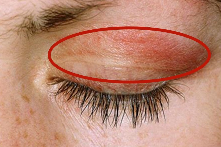皮肌炎眼睑症状图