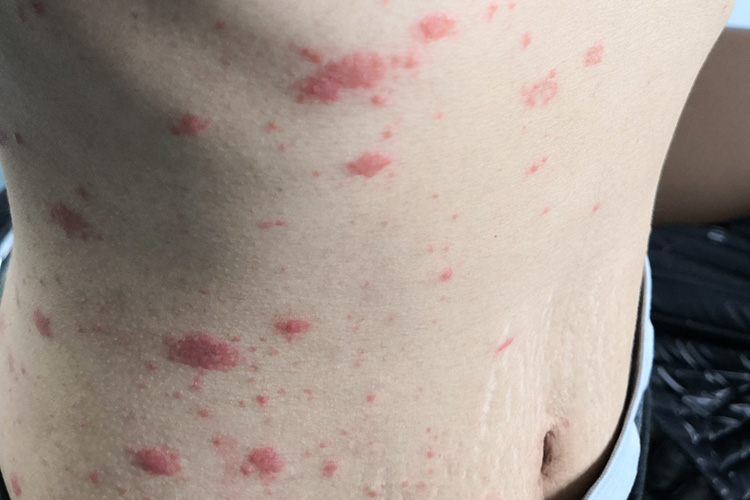 湿疹样丘疱疹图