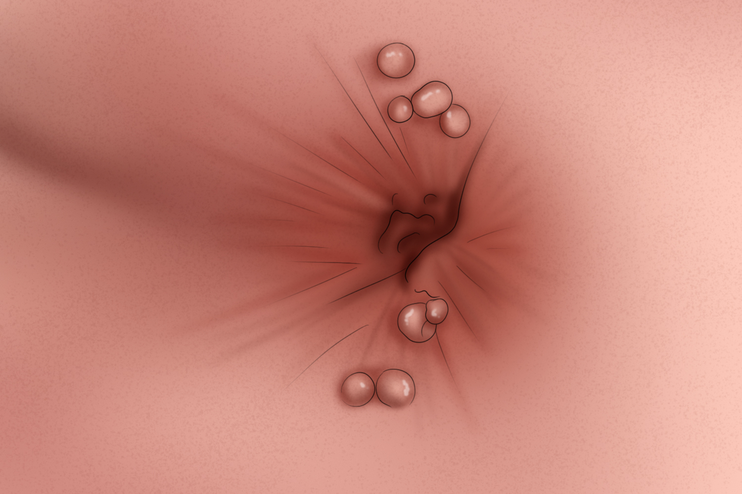 肛周尖锐湿疣图