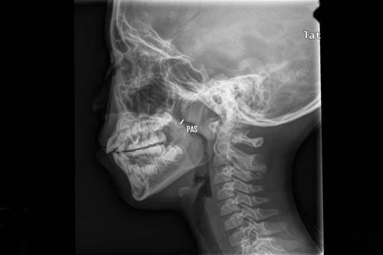 腺样体肥大X线图