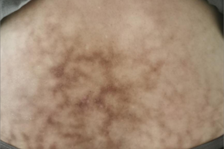 热激红斑症状图