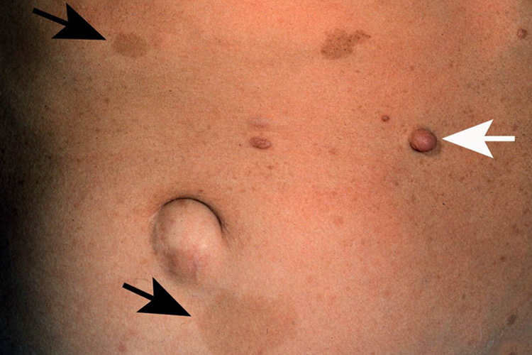 神经纤维瘤斑块图