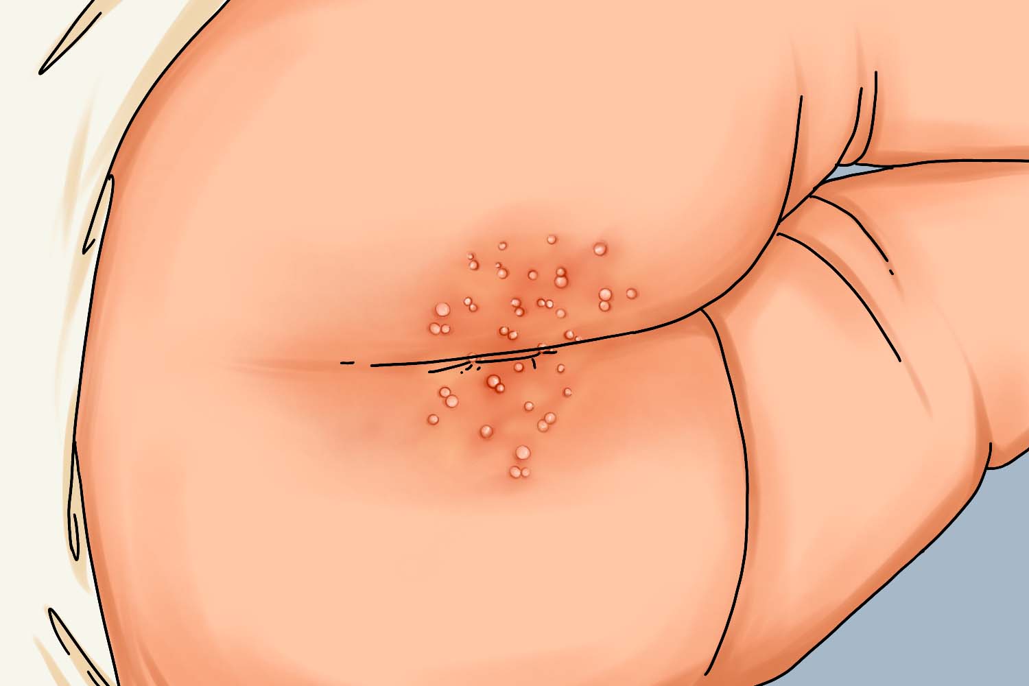 婴儿肛周痱子手绘图